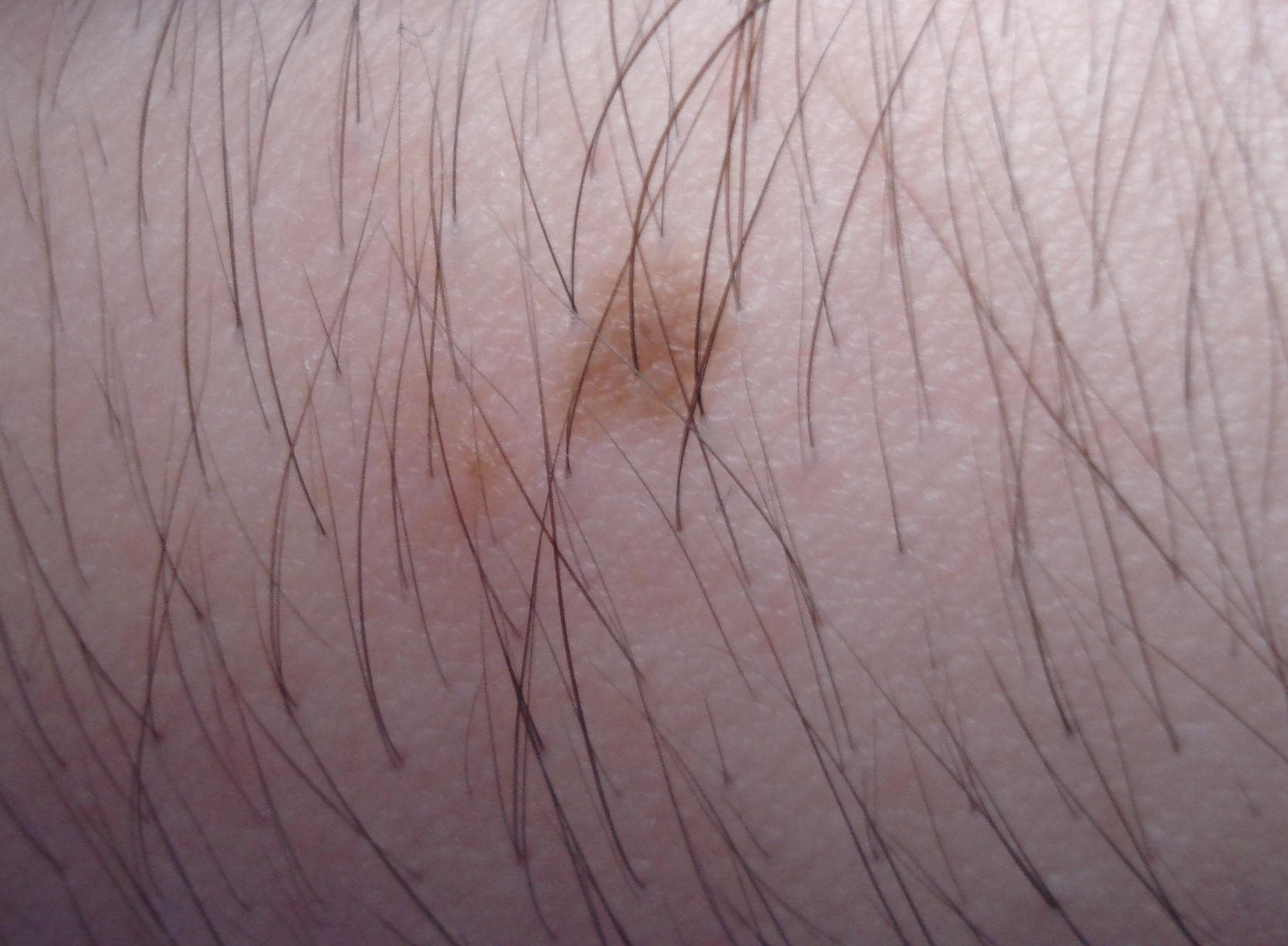 Harmlos — Normales Muttermal